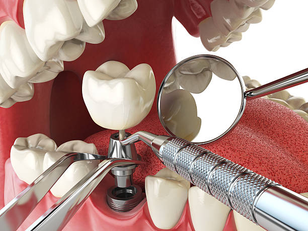 Best Emergency Tooth Extraction  in Boulder, MT
